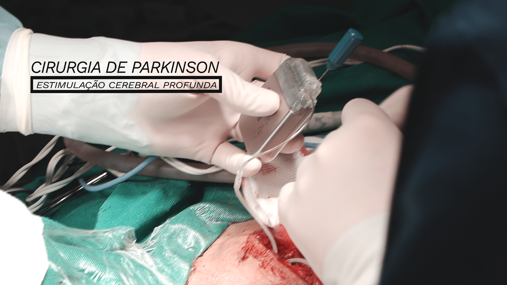 Como a doença de Parkinson se espalha no cérebro? - Blog Cirurgia