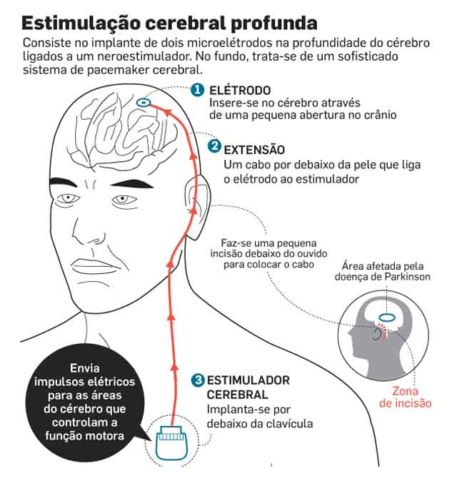 Musicoterapia Como Tratamento Coadjuvante Doenca de Parkinso