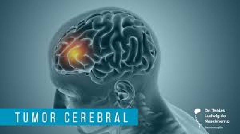 Video Cirurgia de tumor cerebral com paciente acordada