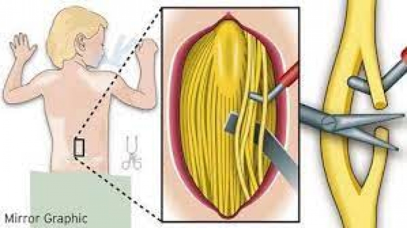 Video Cirurgia-Rizotomia Dorsal Seletiva