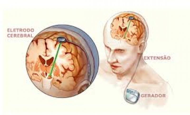 Video Cirurgia - Epilepsia